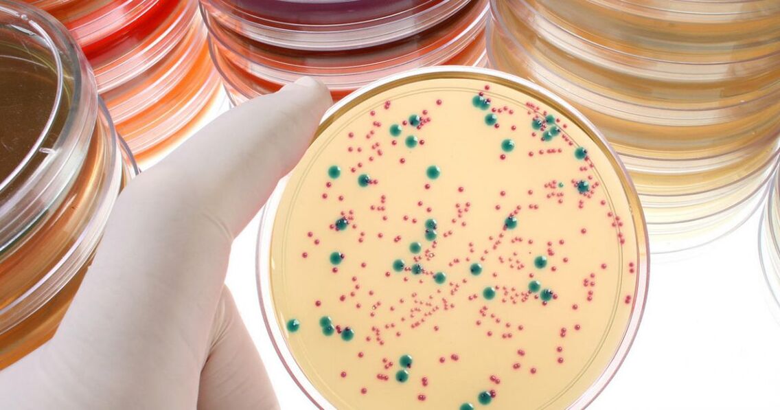 Chronic bacterial prostatitis is detected by analyzing urinary and prostate secretions