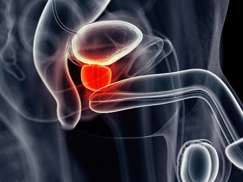 Inflammation of the prostate accompanying chronic prostatitis